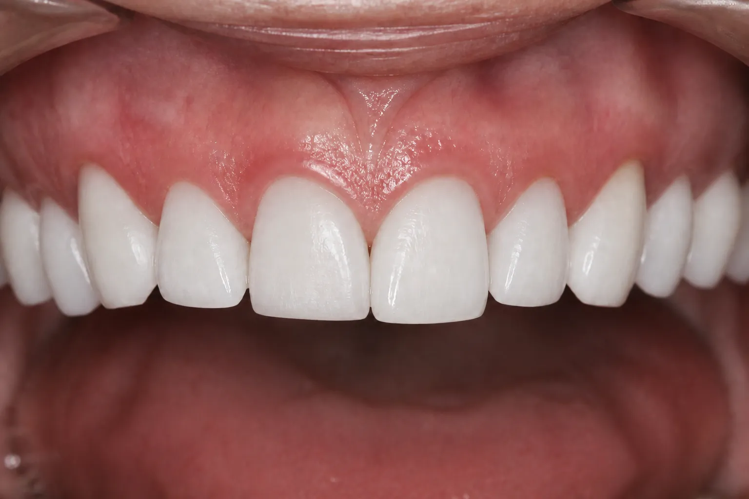 Brighter enamel after professional whitening
