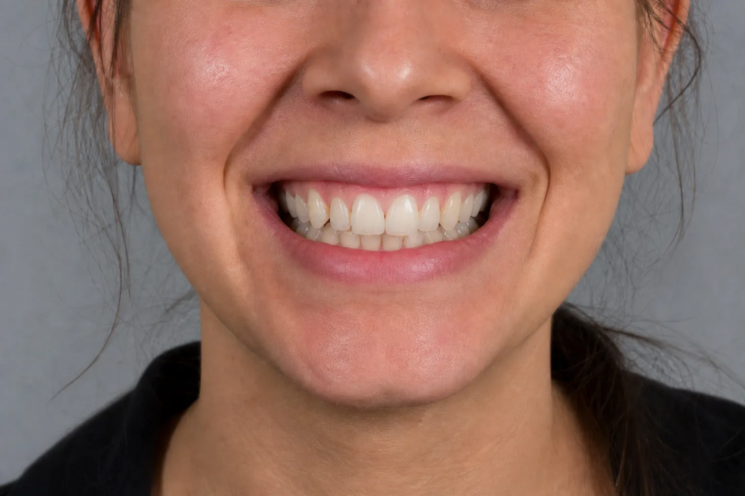 Straighter front teeth after clear-aligner treatment