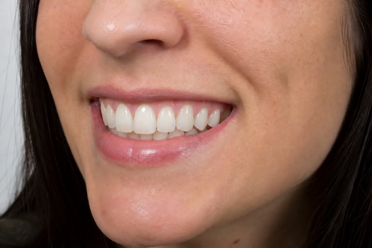 Natural-looking crown after same-day restoration
