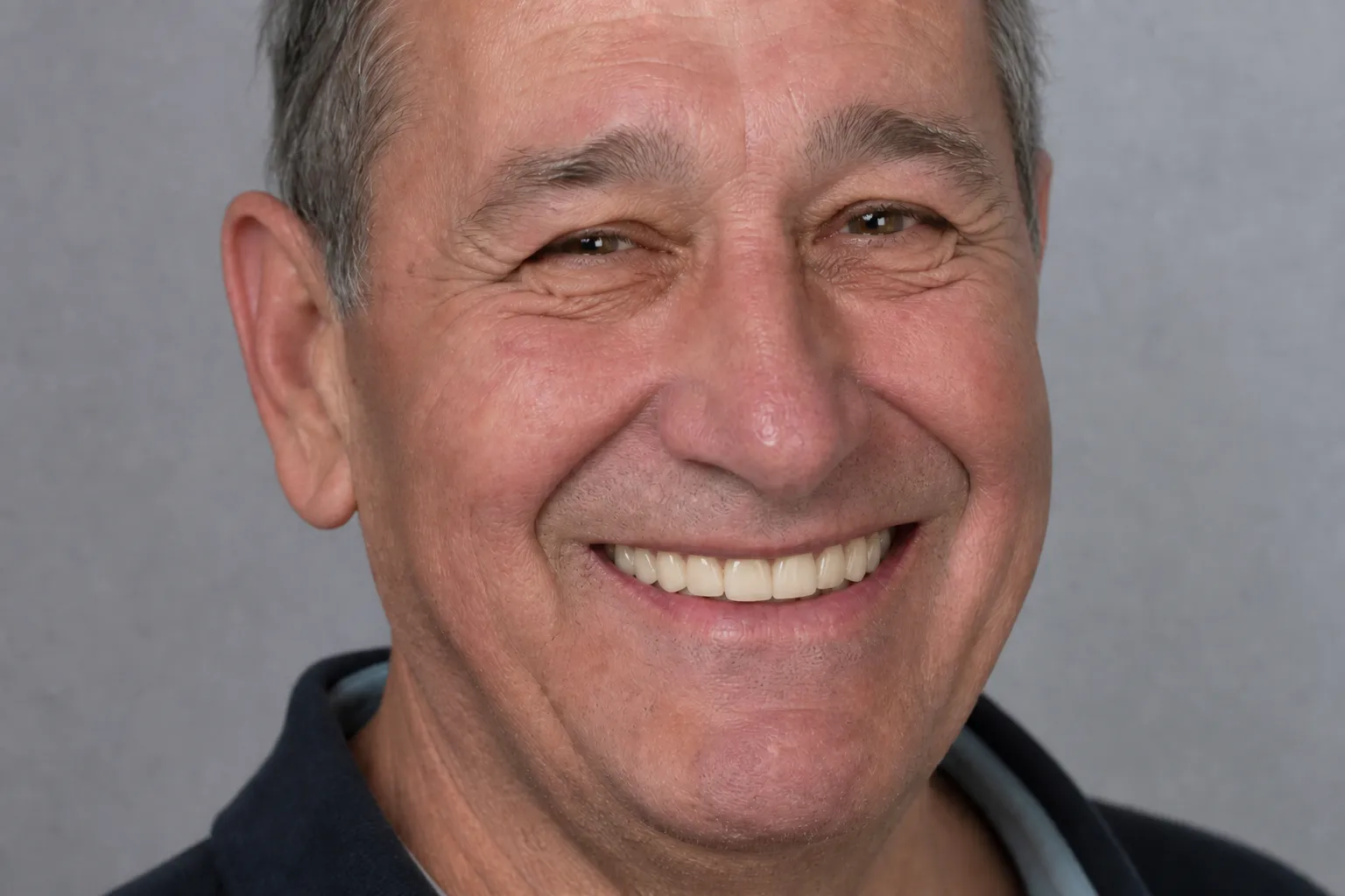 Full-arch teeth after implant-supported restoration