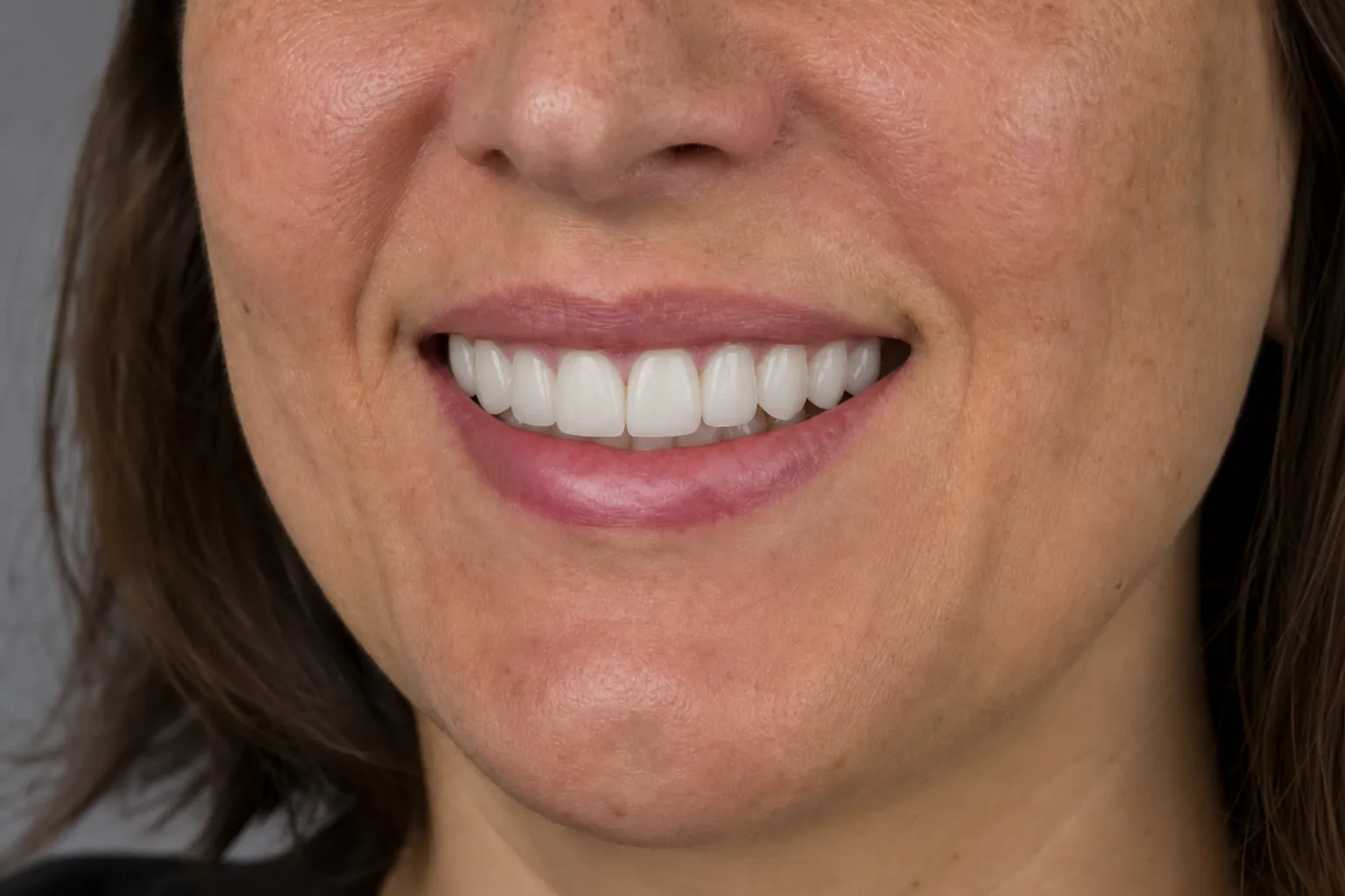 Even front-tooth contour after porcelain veneers