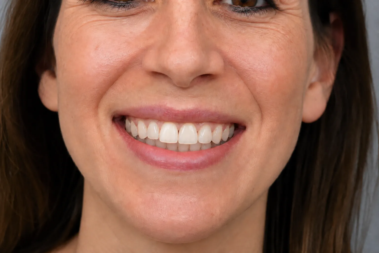 Complete front smile after a single implant crown