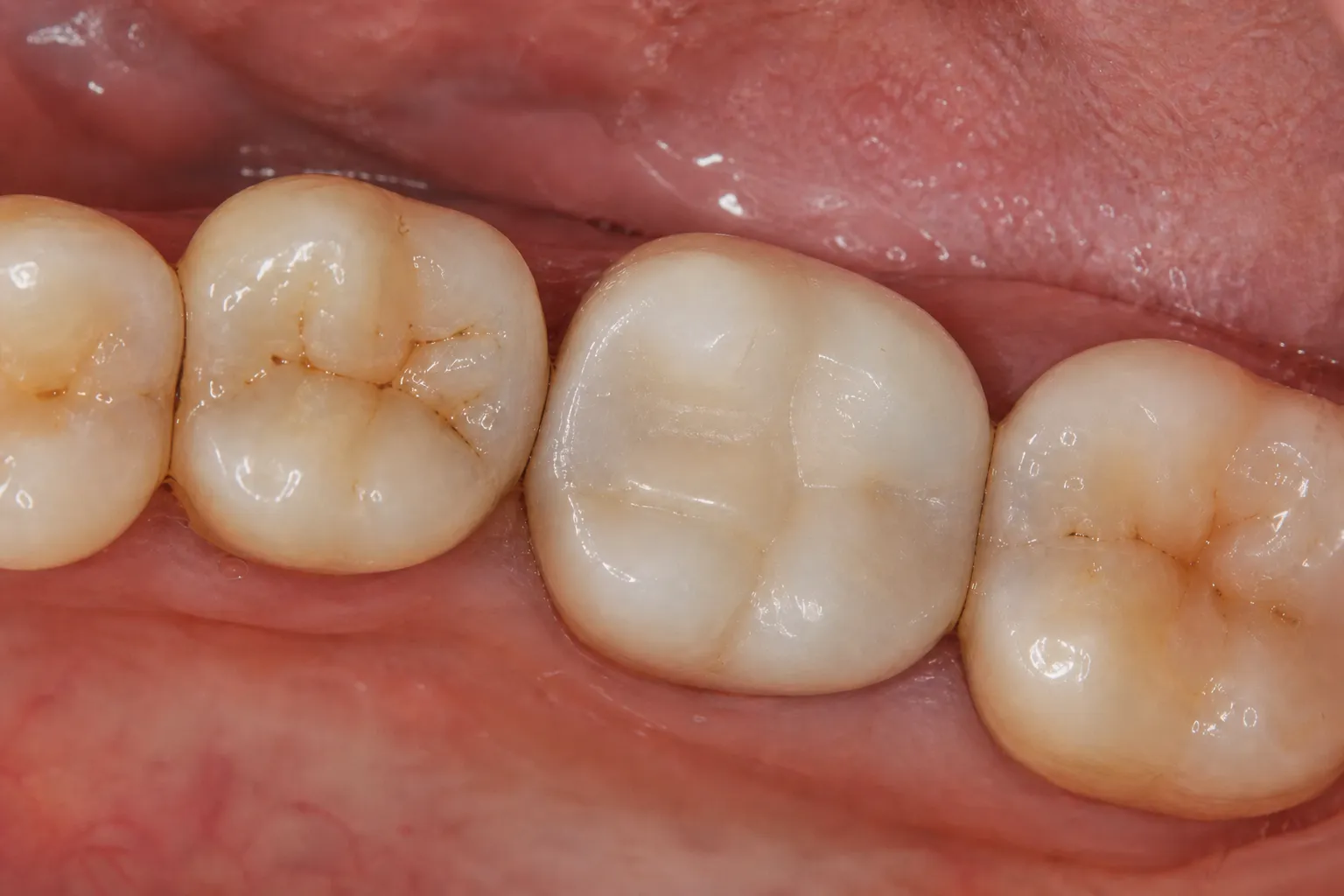 Tooth-coloured bonded restoration after replacement