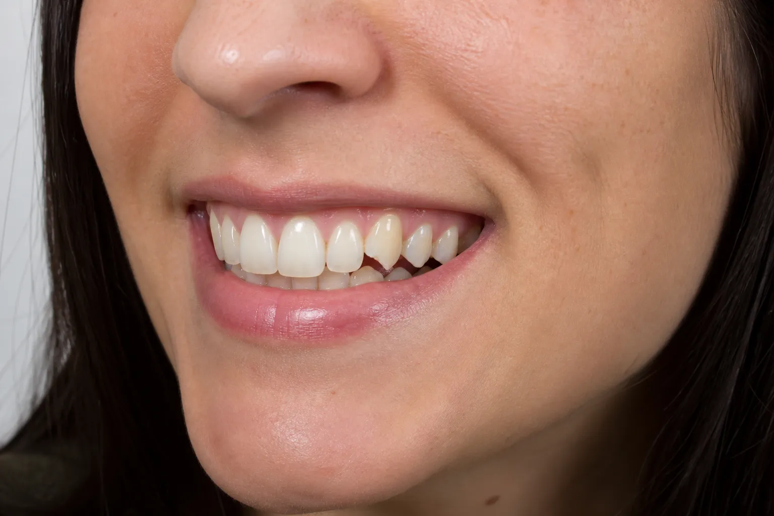 Fractured tooth before a same-day crown