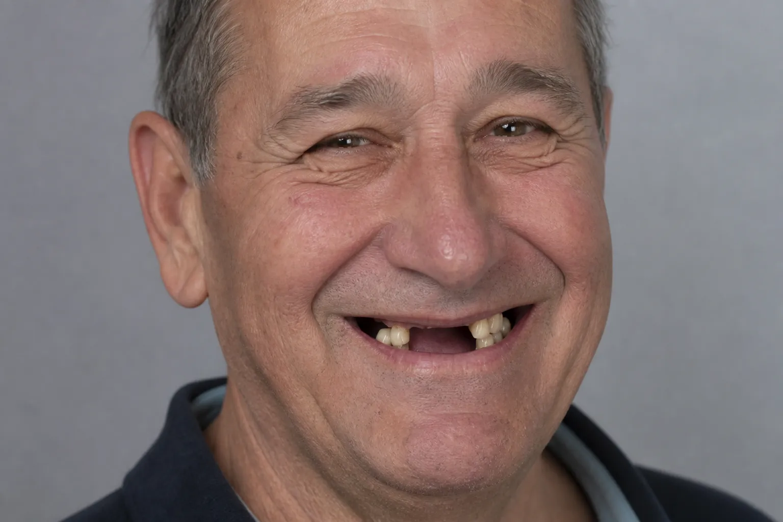 Several missing teeth before full-arch implant restoration