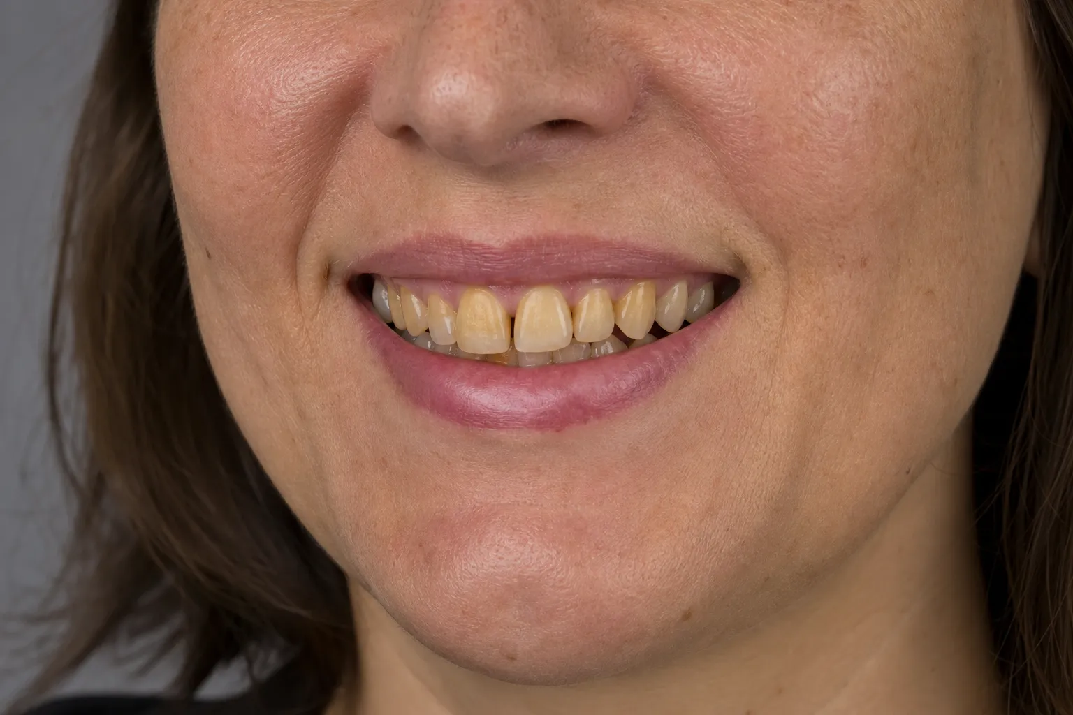 Uneven, discolored front teeth before veneers