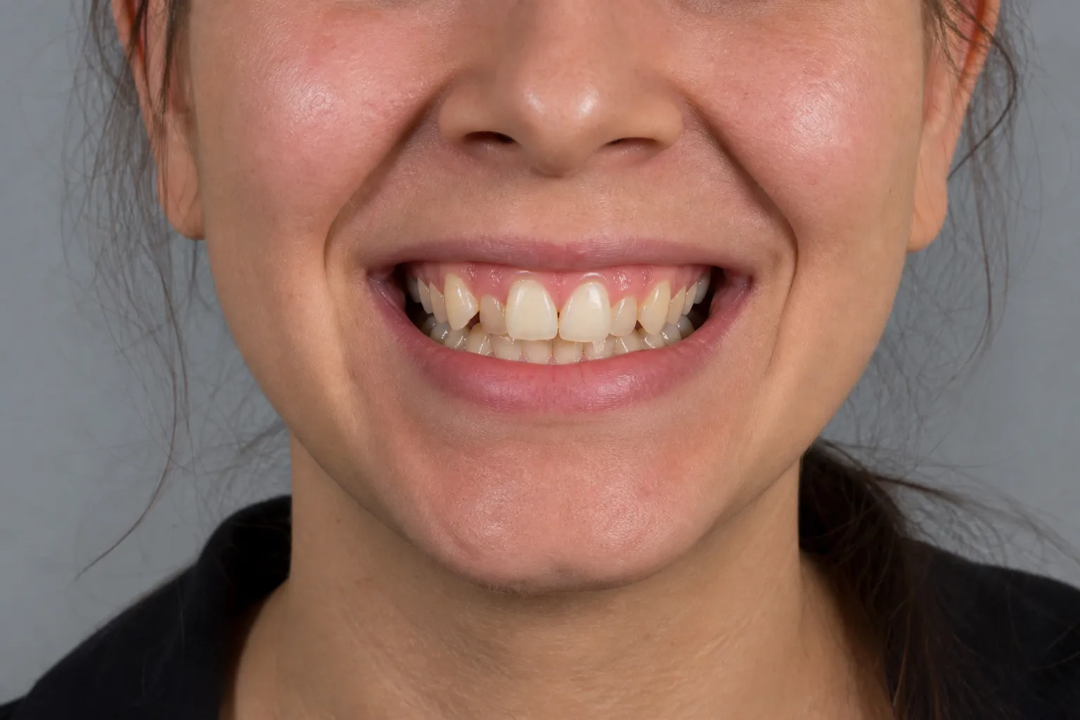 Crowded front teeth before clear aligners