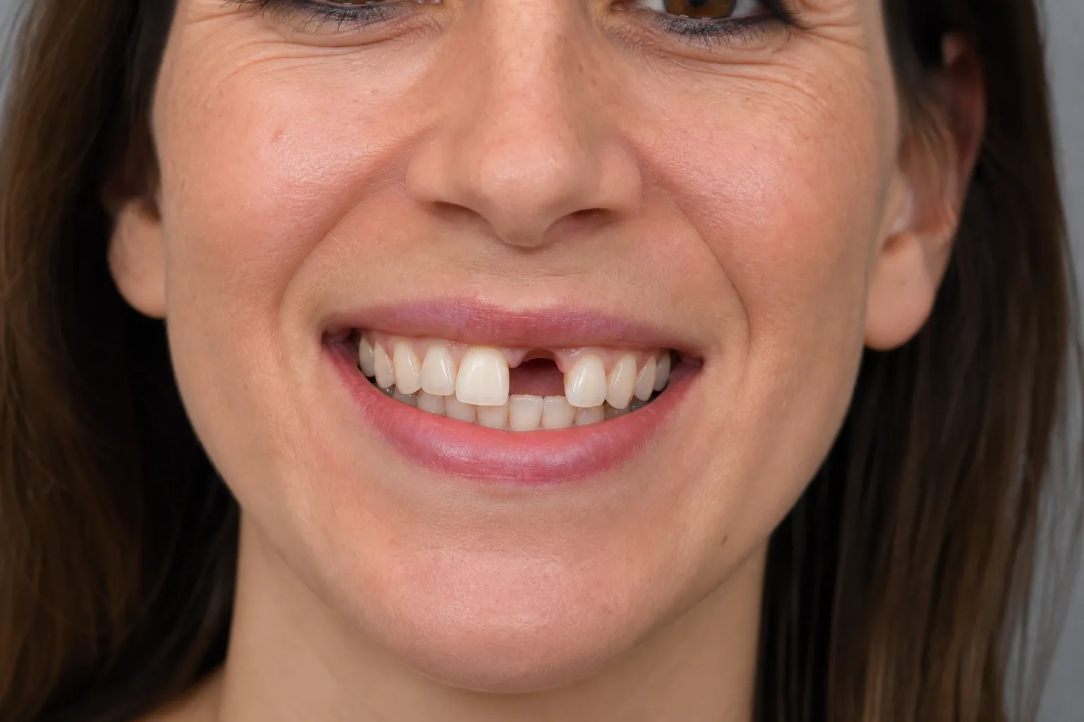 Gap from a missing front tooth before an implant