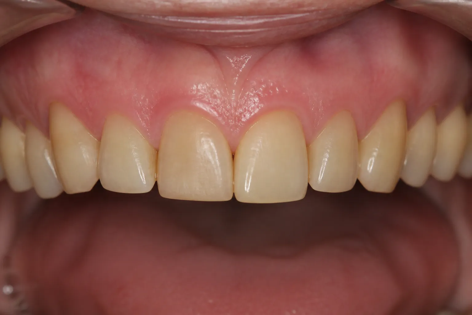 Yellowed enamel before professional whitening